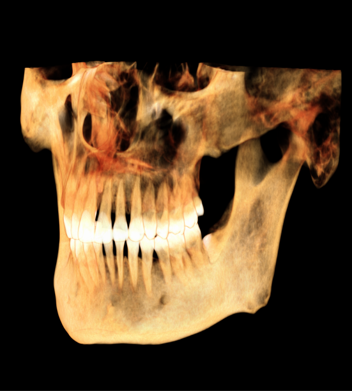 3D reconstruction after spine removal